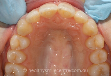 Teeth Cleaning After