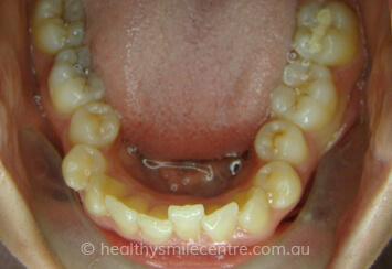 Orthodontics Before
