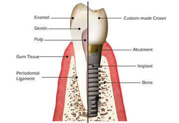 Dental Implants 3