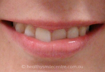 Unaligned Teeth Before