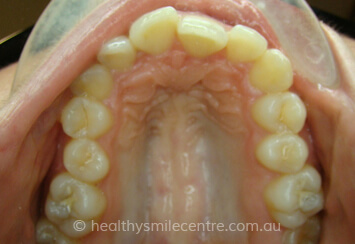 Teeth Cleaning Before