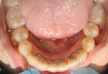 Orthodontics After