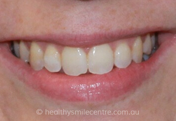 Unaligned Teeth After